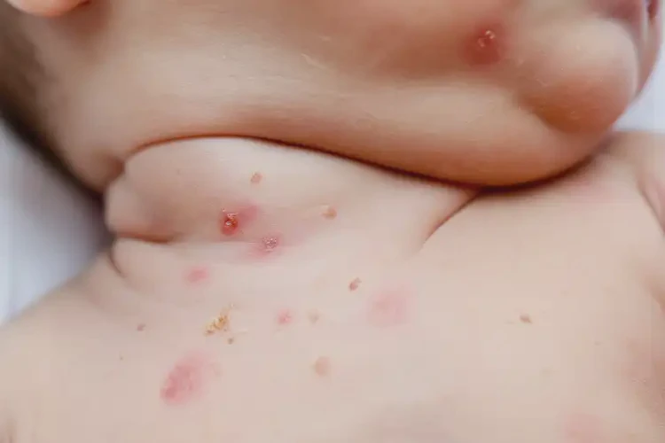 新生兒脖子上偶爾長濕疹不管它會自己自愈嗎(圖4)