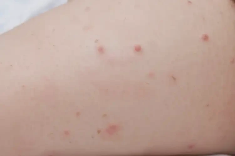 嬰兒大腿上偶爾長濕疹能夠徹底治愈嗎(圖4)