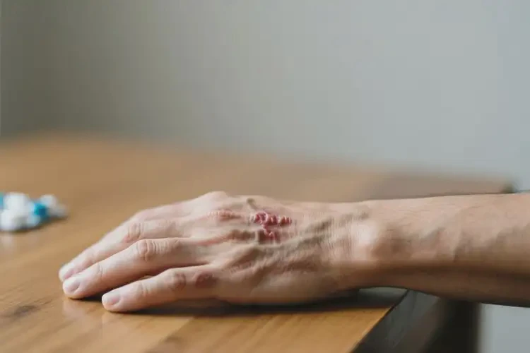 男性手上起濕疹不管它會(huì)自己痊愈嗎(圖3)