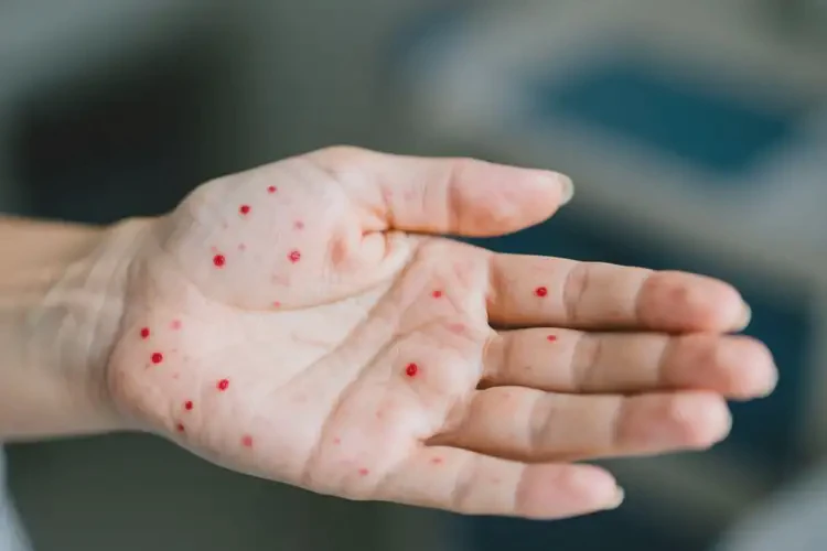 女人手上偶爾起濕疹能夠徹底治愈嗎(圖2)