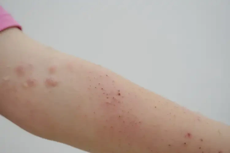 少兒身上容易起濕疹不管它會自己好嗎(圖4)