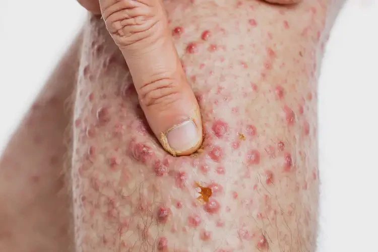 男性小腿上偶爾長濕疹可不可以徹底自愈(圖2)