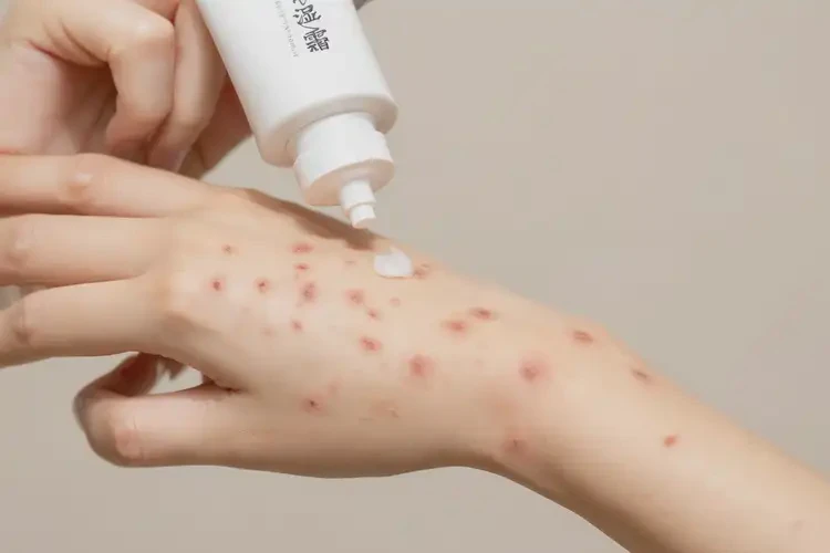 女人手上出現(xiàn)濕疹不管它會(huì)自己自愈嗎(圖3)