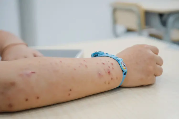 小学生手臂起湿疹能不能彻底自愈(图3)