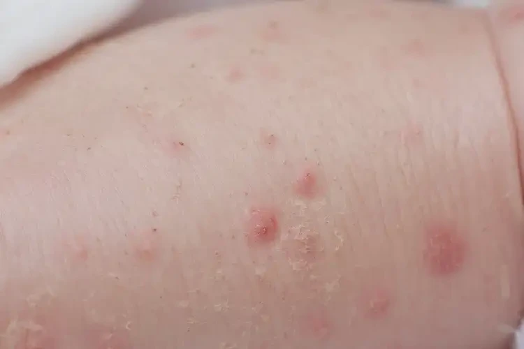 新生兒小腿上偶爾起濕疹不管它會自己自愈嗎(圖4)