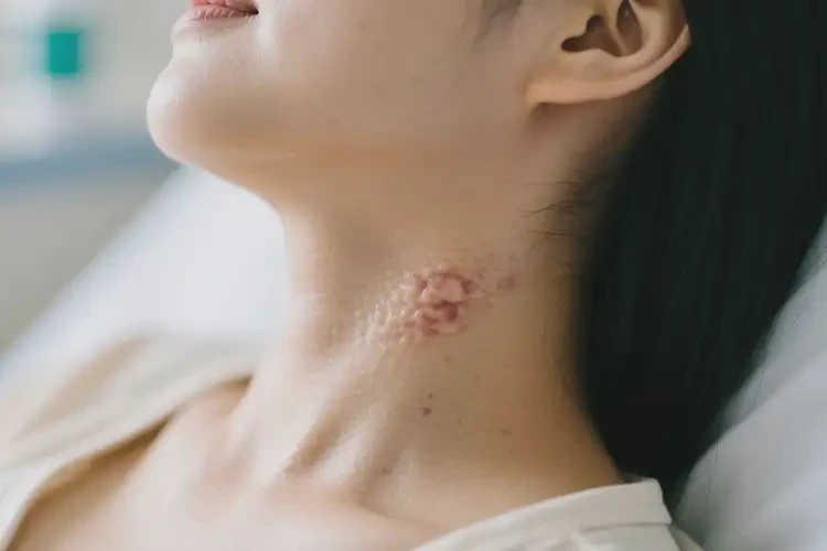 產(chǎn)婦脖子上經(jīng)常長濕疹能徹底自愈嗎(圖3)