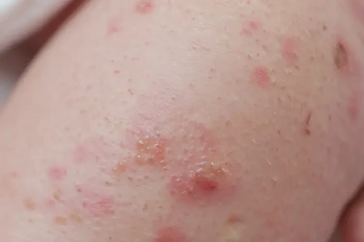 新生兒小腿容易起濕疹可不可以徹底自愈(圖4)
