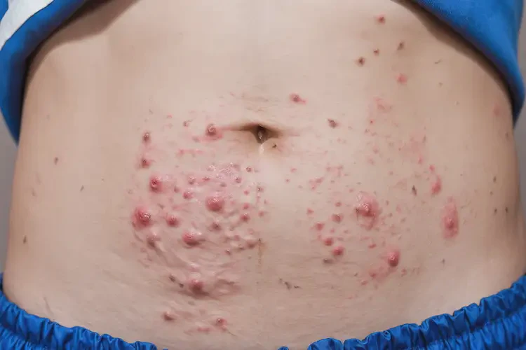 中学生肚子经常长湿疹不管它会自己自愈吗(图4)