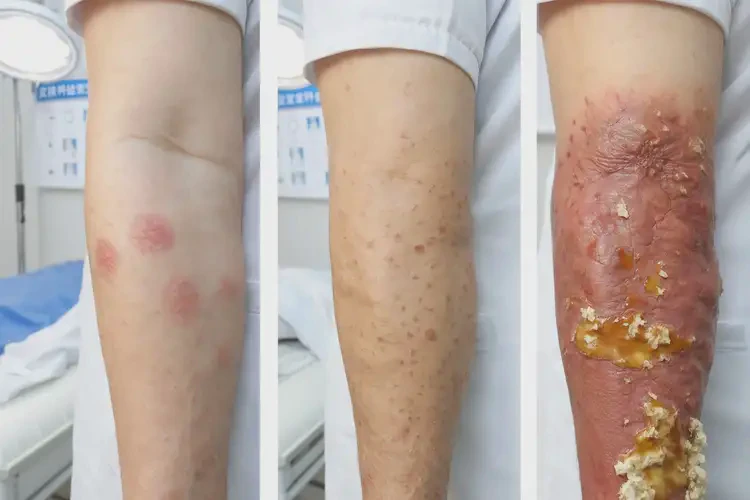 老人脖子偶爾長濕疹不管它會自己痊愈嗎(圖2)