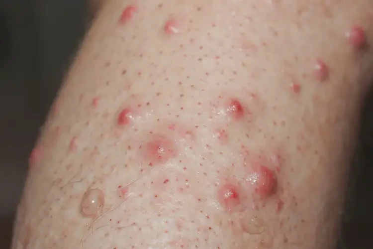 男性小腿上經(jīng)常長濕疹能夠徹底治愈嗎(圖4)