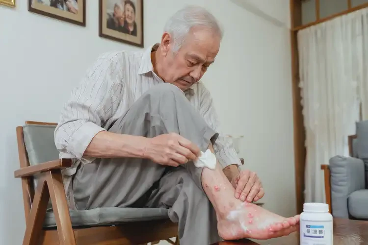 老年人腳上出濕疹不管它會(huì)自己好嗎(圖1)