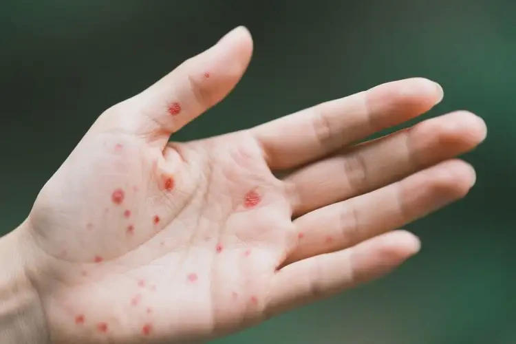 女人手上偶爾起濕疹能夠徹底治愈嗎(圖3)