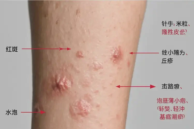 大學(xué)生脖子上有濕疹不管它會(huì)自己好嗎(圖4)