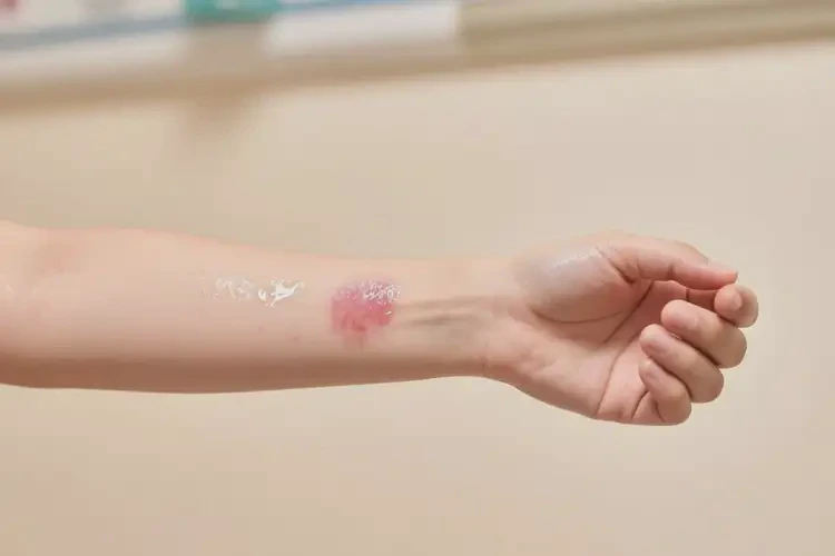 女人手臂起濕疹不管它會自己自愈嗎(圖3)