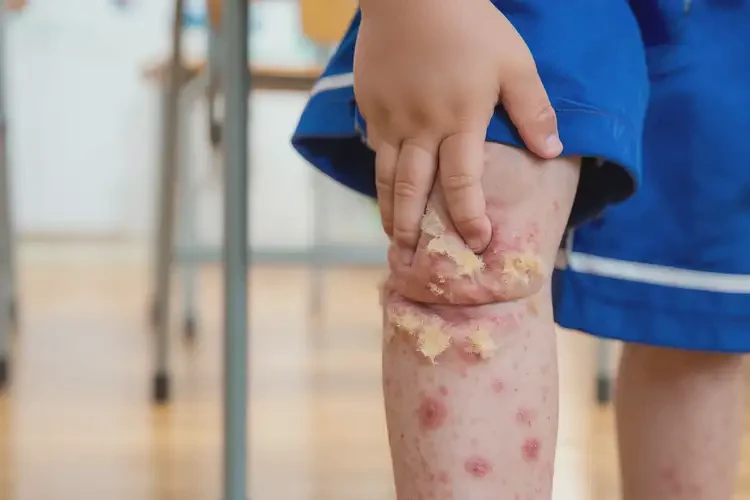 小學(xué)生小腿長濕疹不管它會自己自愈嗎(圖2)