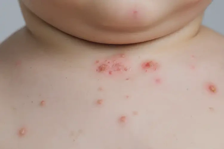 幼兒脖子上出現(xiàn)濕疹能徹底自愈嗎(圖3)