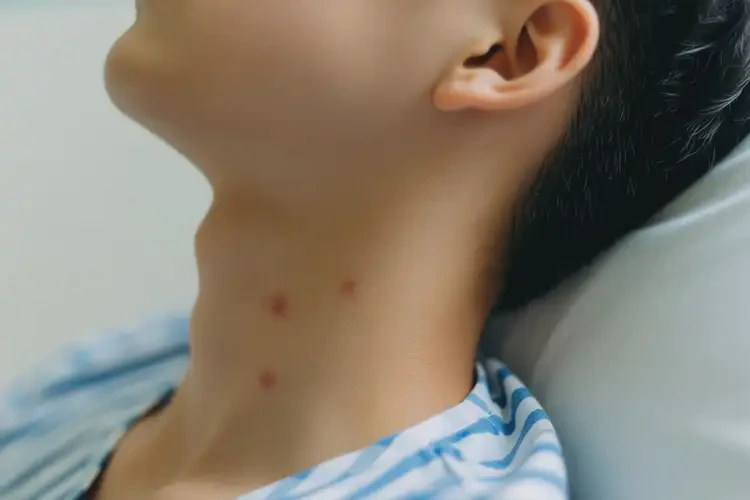 青少年脖子上容易長濕疹能靠自己自愈嗎(圖4)