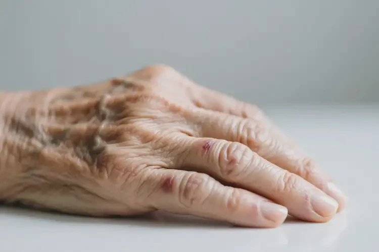 高齡老人身上偶爾長濕疹能夠徹底治愈嗎(圖3)