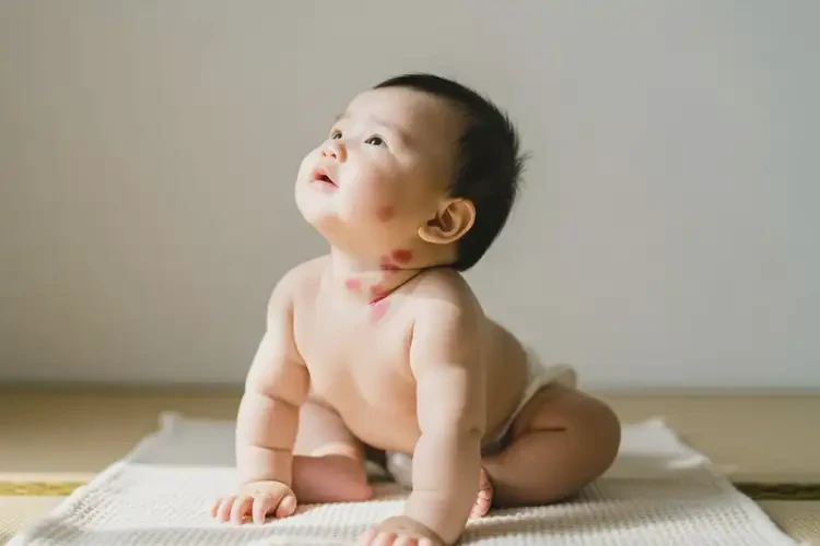 嬰兒脖子上偶爾長(zhǎng)濕疹不管它會(huì)自己好嗎(圖1)