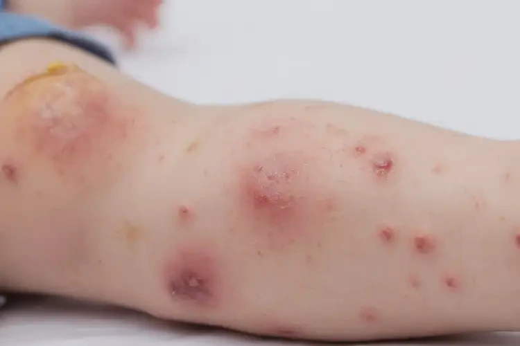 少儿小腿出湿疹能靠自己自愈吗(图3)