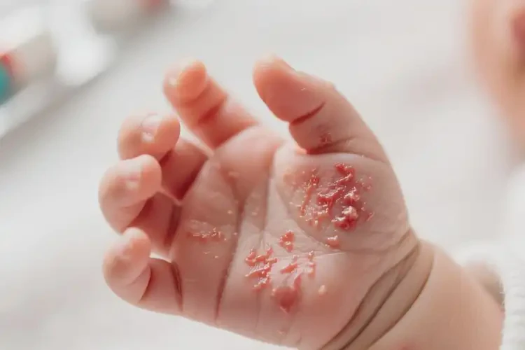 小兒手上容易長濕疹不管它會自己好嗎(圖4)