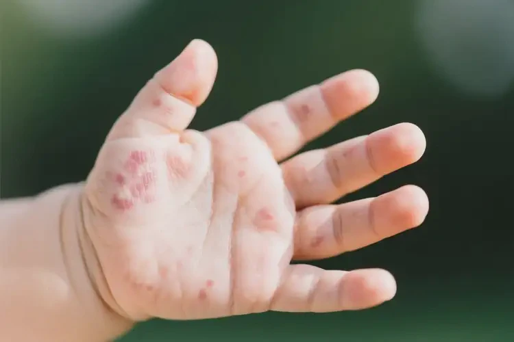 嬰兒手上出濕疹不管它會自己自愈嗎(圖1)