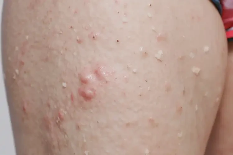 孩子大腿上出現(xiàn)濕疹能靠自己自愈嗎(圖2)