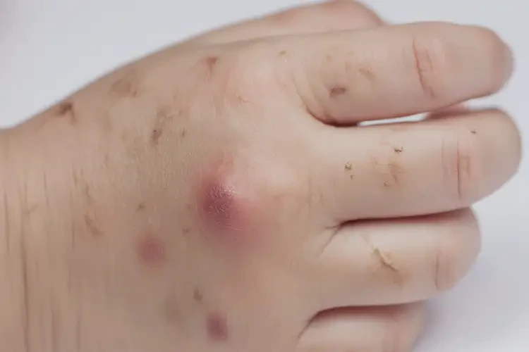 孩子手上出濕疹能靠自己自愈嗎(圖4)