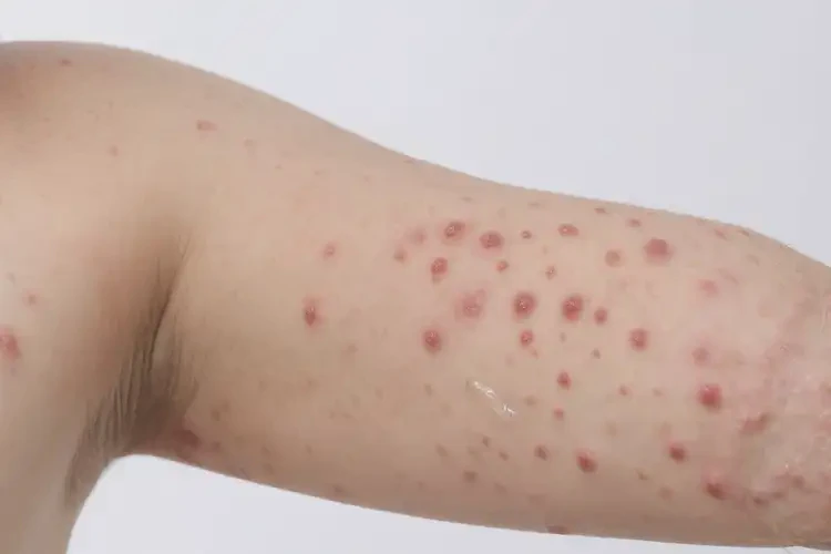 青少年手臂上出現(xiàn)濕疹不管它會自己痊愈嗎(圖2)