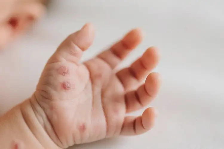 新生兒手上出濕疹可以徹底自愈嗎(圖4)