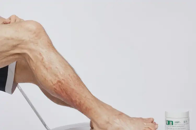 青年人小腿上偶爾長濕疹能徹底自愈嗎(圖3)