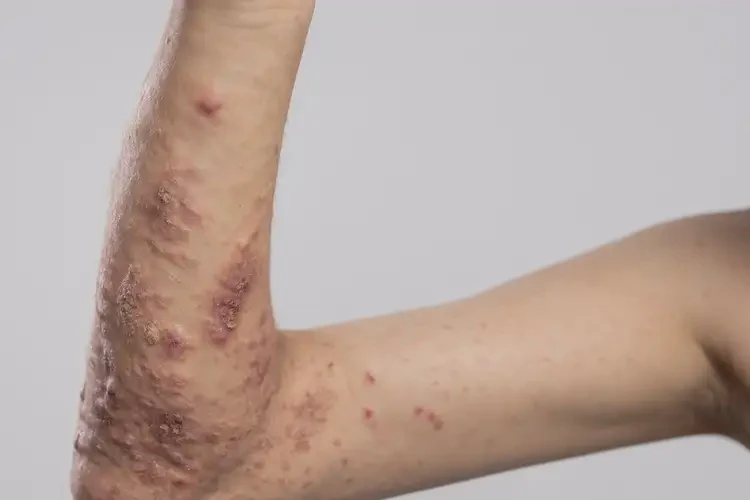 青少年身上起濕疹可以徹底自愈嗎(圖2)