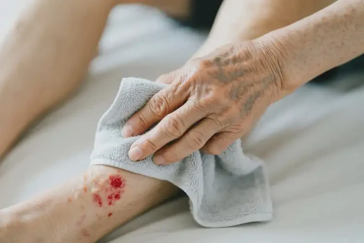 老人小腿上偶尔起湿疹能彻底自愈吗(图3)