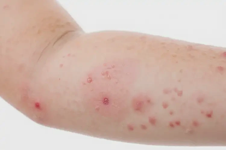 儿童手臂出现湿疹能彻底自愈吗(图3)