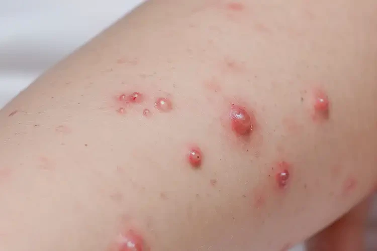 小學(xué)生手臂容易起濕疹能夠徹底治愈嗎(圖4)