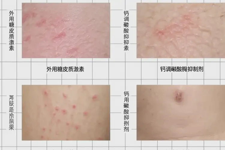 男人大腿上起濕疹不管它會自己好嗎(圖2)