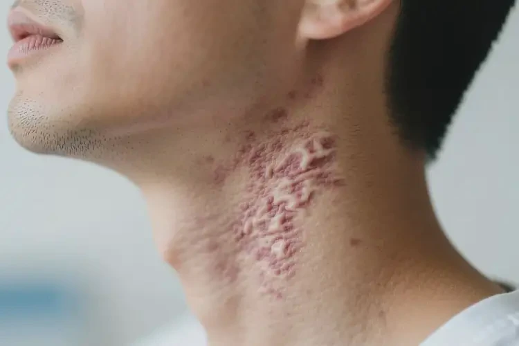 男人脖子出現(xiàn)濕疹可以徹底自愈嗎(圖2)