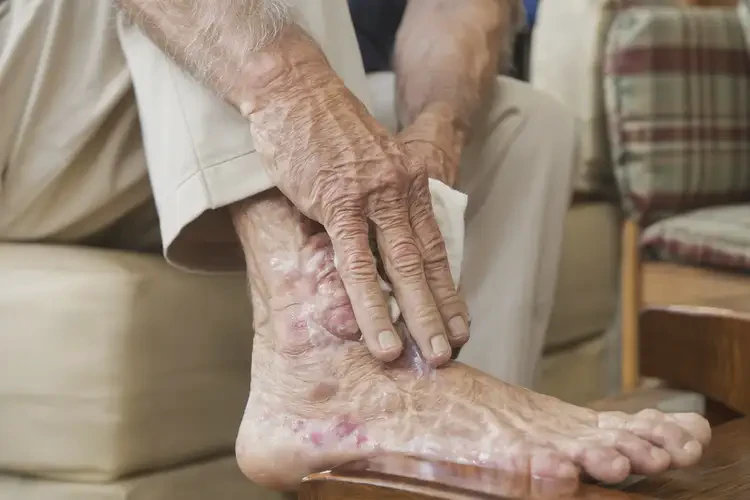 高齡老人腳上長濕疹能徹底自愈嗎(圖2)