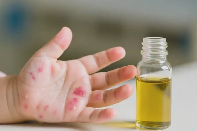 小兒手上偶爾起濕疹可以徹底自愈嗎(圖3)