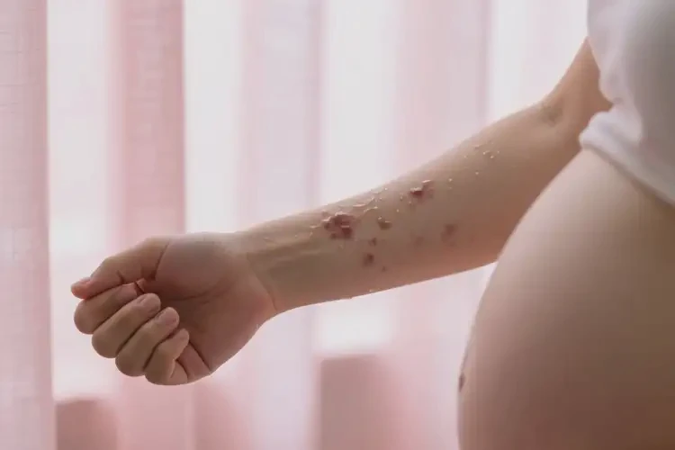 产妇手臂上有湿疹能彻底自愈吗(图1)