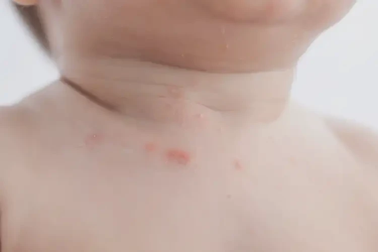 嬰兒脖子上起濕疹能夠徹底治愈嗎(圖3)