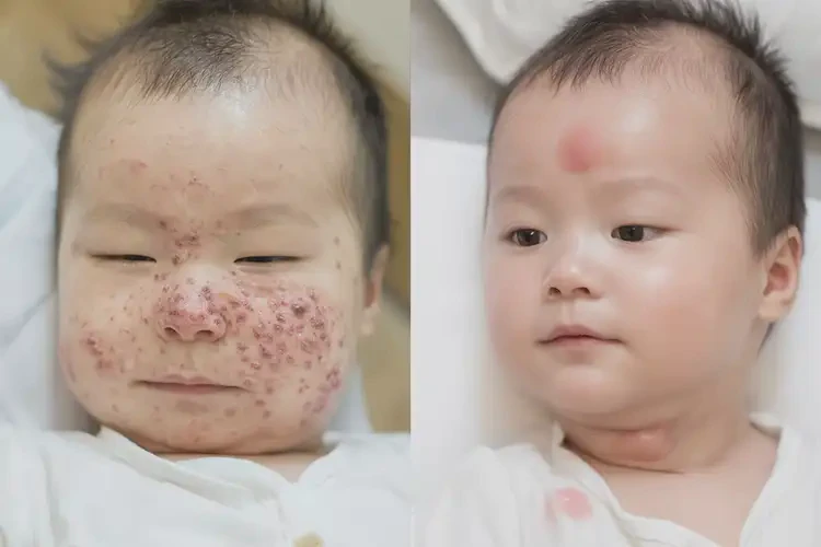 小兒肚子上經(jīng)常長(zhǎng)濕疹可不可以徹底自愈(圖2)
