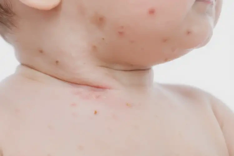寶寶脖子容易長(zhǎng)濕疹可以徹底自愈嗎(圖4)