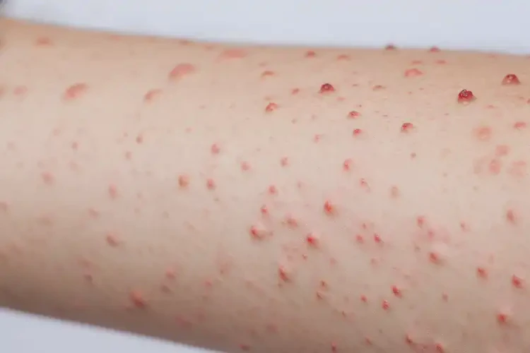 大學生手臂上偶爾長濕疹能徹底自愈嗎(圖4)