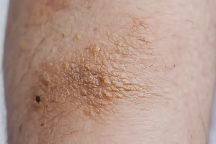 男人大腿上起濕疹不管它會自己好嗎(圖3)