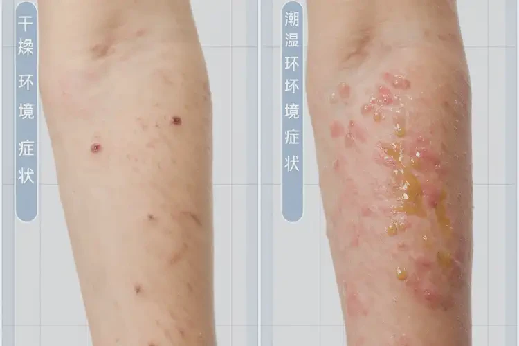 男人屁股上偶爾起濕疹不管它會自己自愈嗎(圖1)