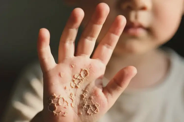 小孩手上長濕疹能徹底自愈嗎(圖2)