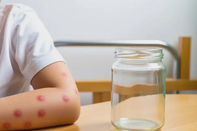 孩子身上出現(xiàn)濕疹不管它會自己痊愈嗎(圖3)