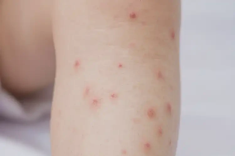 少兒小腿有濕疹不管它會自己好嗎(圖4)