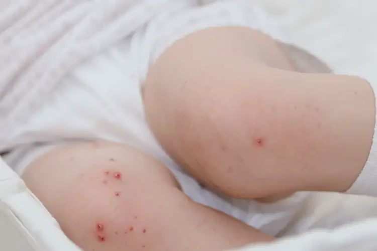 新生兒大腿偶爾起濕疹不管它會(huì)自己好嗎(圖4)